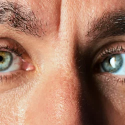 Şaşılık Tedavisi ve Ameliyatı